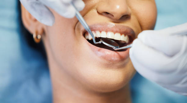 Best Knocked-Out Tooth (Avulsed Tooth) Treatment in Greensboro, MD