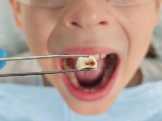 Best Emergency Treatment for Oral Infections in Greensboro, MD